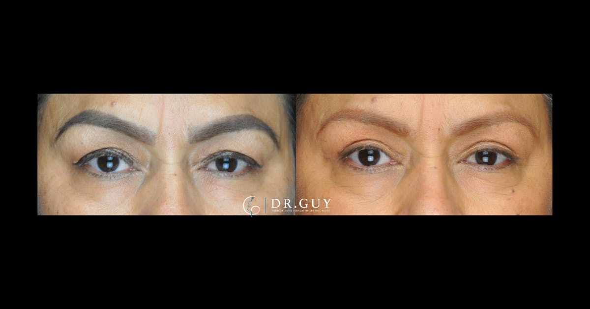 Upper Blepharoplasty Before & After Gallery - Patient 392372 - Image 3