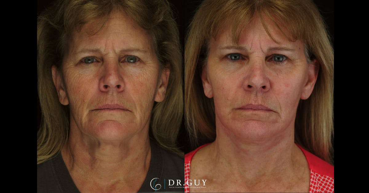 Laser Before & After Gallery - Patient 213737 - Image 3