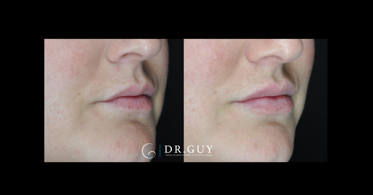 Fillers Before & After Gallery - Patient 588675 - Image 2