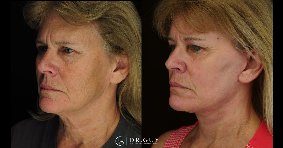 Laser Before & After Gallery - Patient 213737 - Image 4