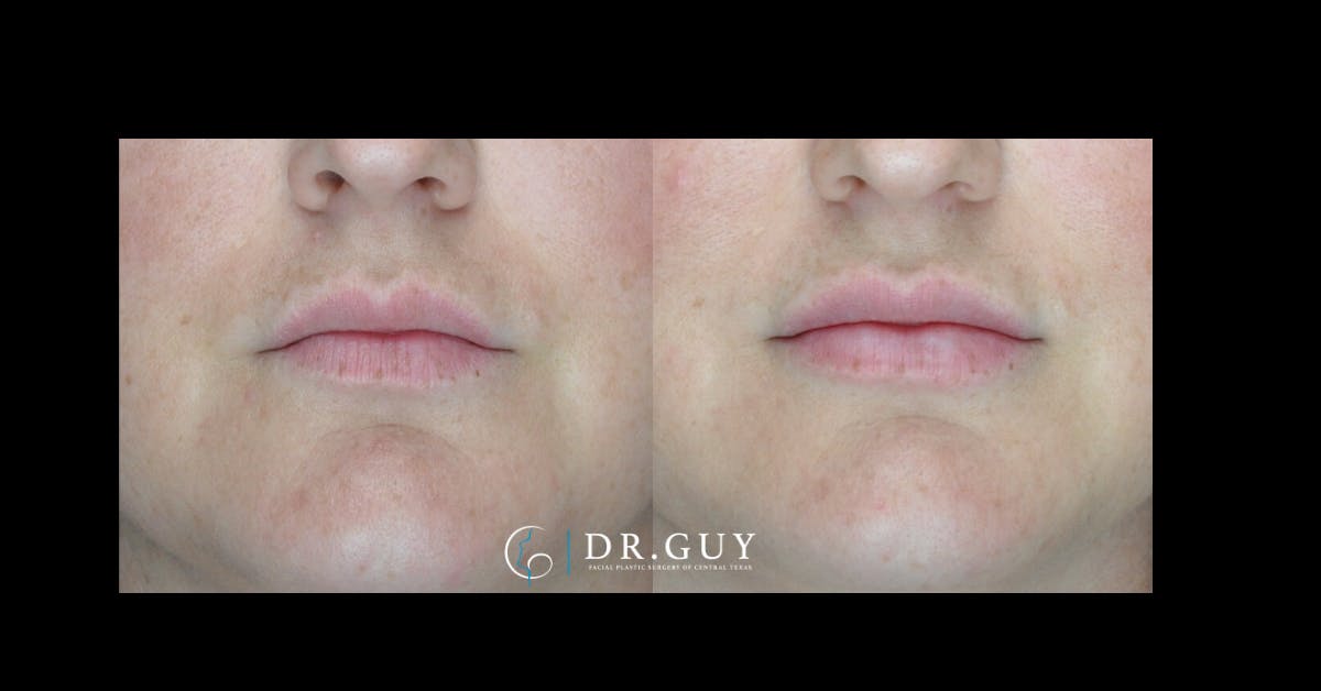 Fillers Before & After Gallery - Patient 588675 - Image 3