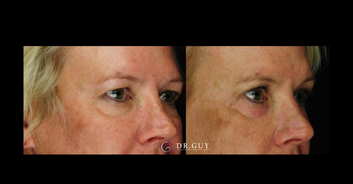 Upper Blepharoplasty Before & After Gallery - Patient 256947 - Image 2