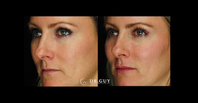 Fillers Before & After Gallery - Patient 334825 - Image 1