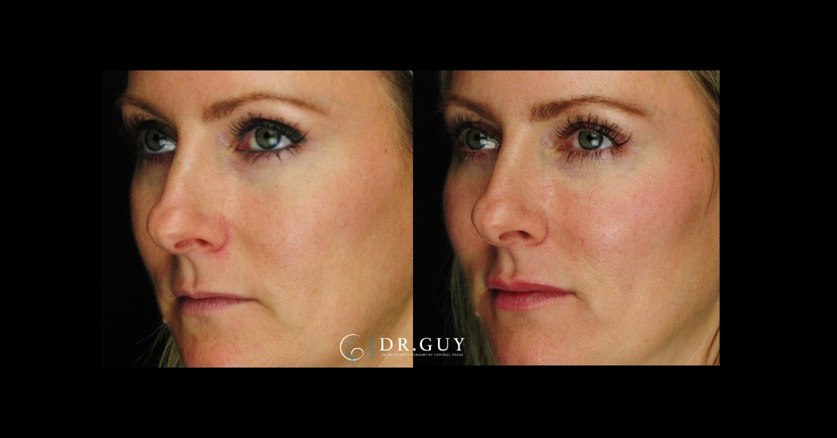 Fillers Before & After Gallery - Patient 334825 - Image 1