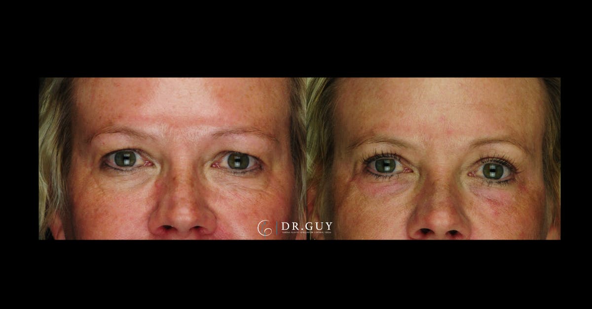 Upper Blepharoplasty Before & After Gallery - Patient 256947 - Image 3