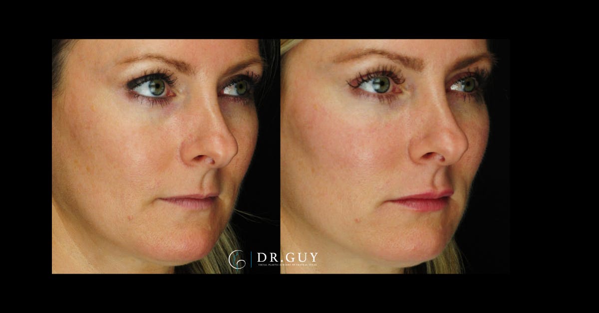 Fillers Before & After Gallery - Patient 334825 - Image 2