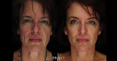 Laser Before & After Gallery - Patient 274281 - Image 1