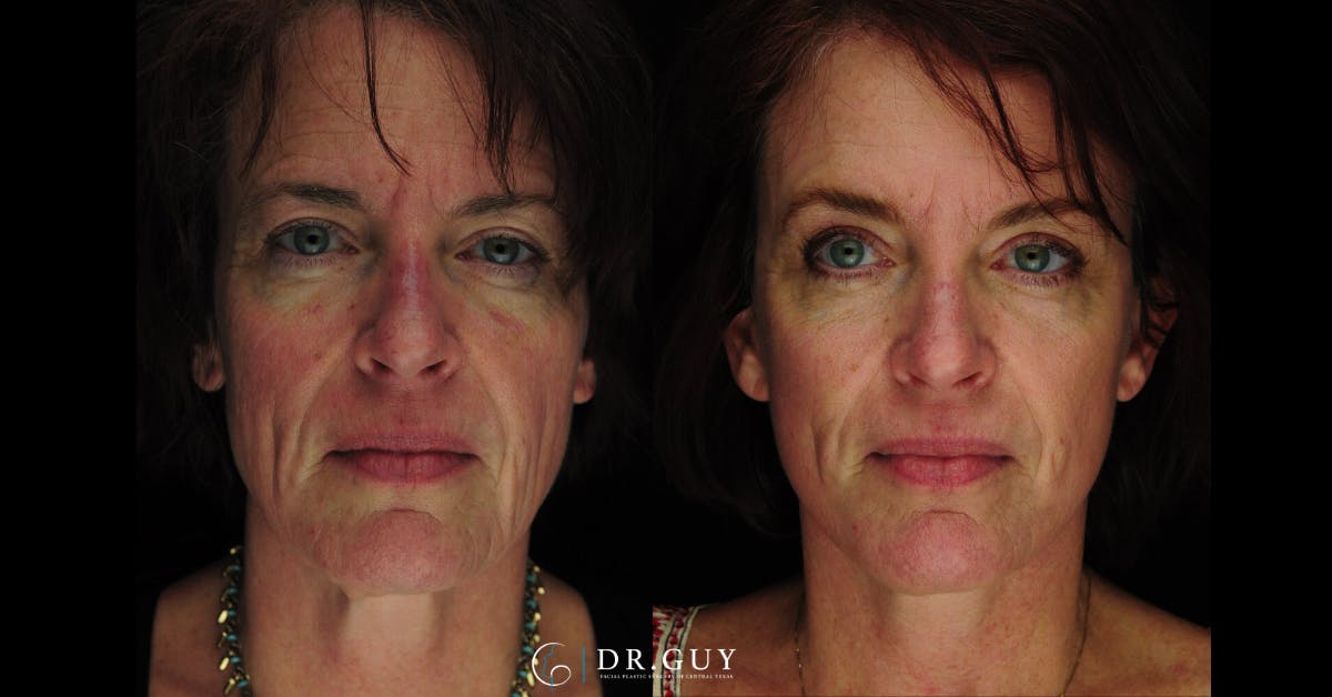 Laser Before & After Gallery - Patient 274281 - Image 1