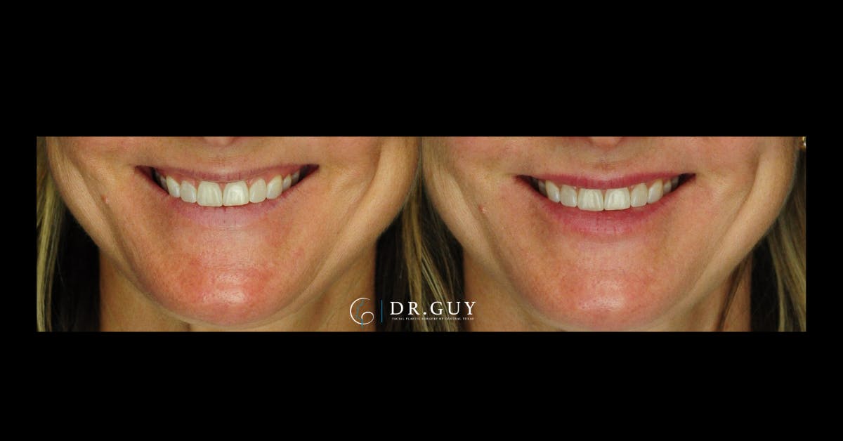 Fillers Before & After Gallery - Patient 334825 - Image 3