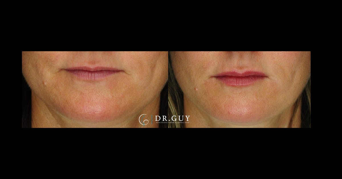 Fillers Before & After Gallery - Patient 334825 - Image 4
