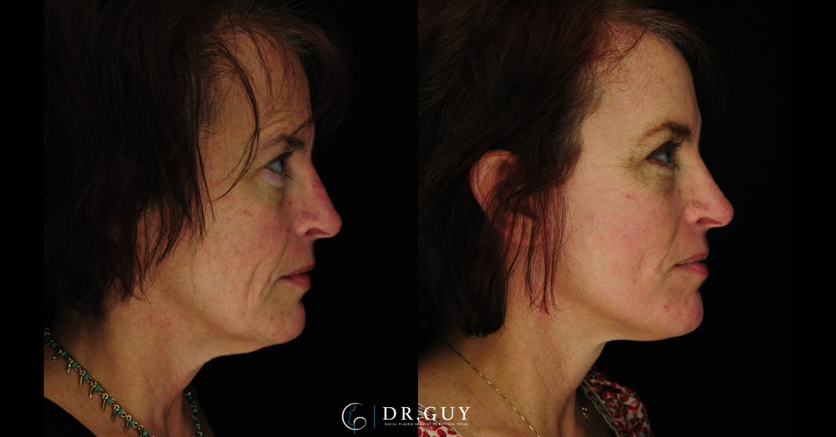Laser Before & After Gallery - Patient 274281 - Image 3