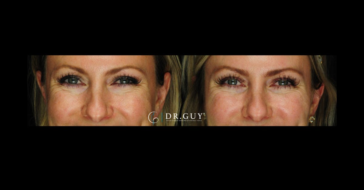Fillers Before & After Gallery - Patient 334825 - Image 5