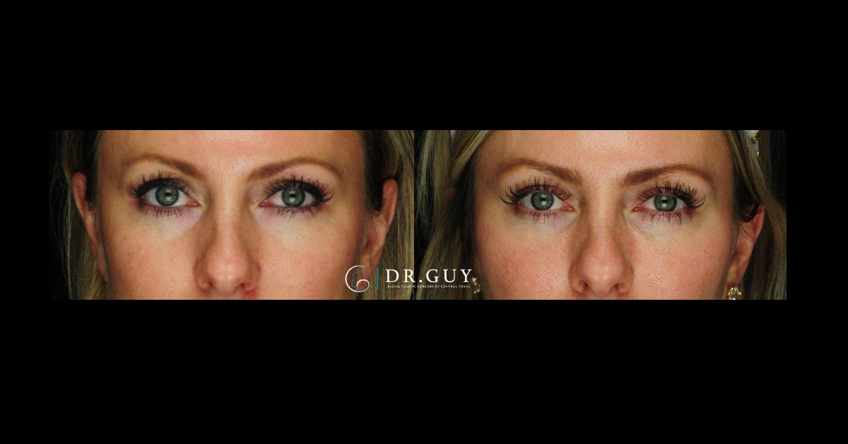Fillers Before & After Gallery - Patient 334825 - Image 6