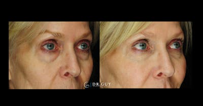 Fillers Before & After Gallery - Patient 278314 - Image 1