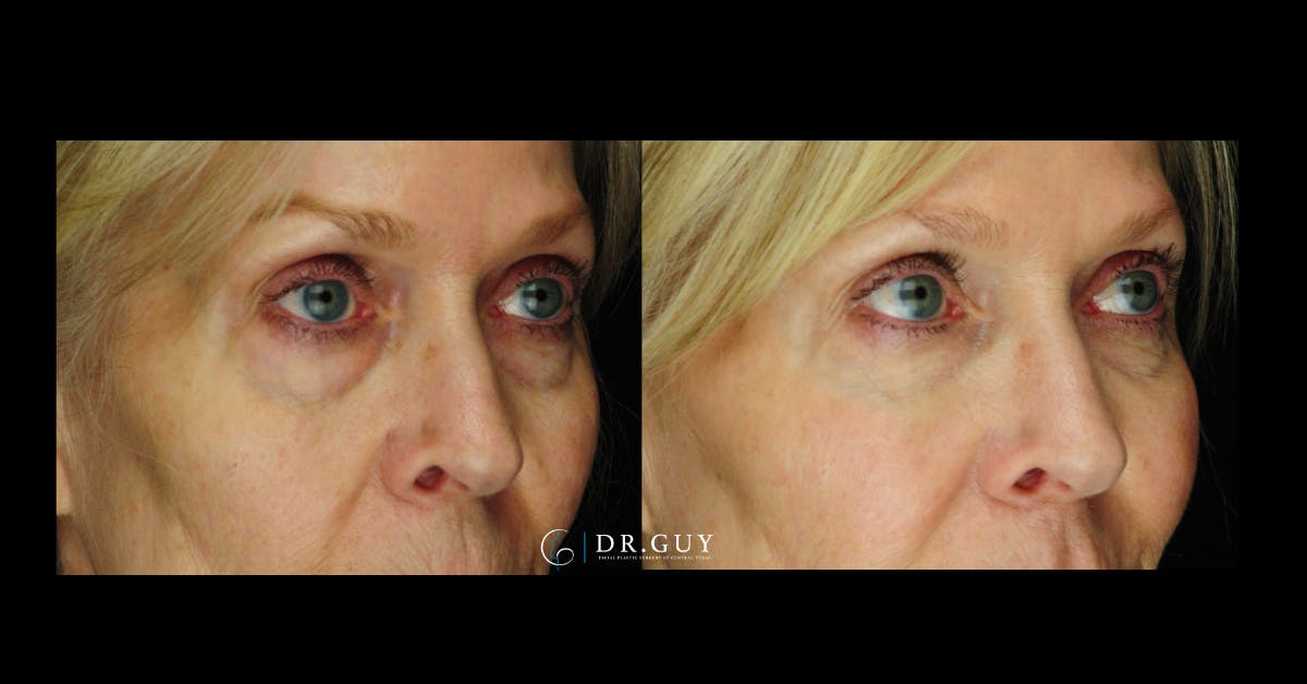 Fillers Before & After Gallery - Patient 278314 - Image 1