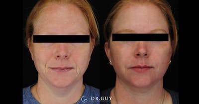 Laser Before & After Gallery - Patient 513630 - Image 1