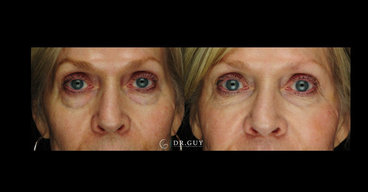 Fillers Before & After Gallery - Patient 278314 - Image 2