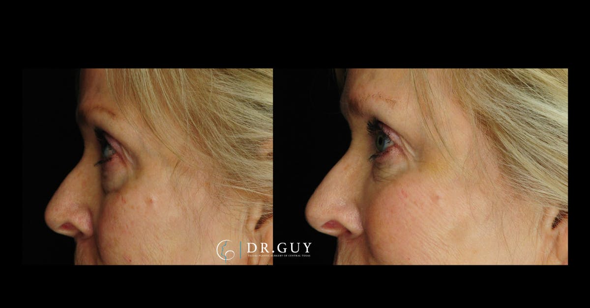 Fillers Before & After Gallery - Patient 278314 - Image 3