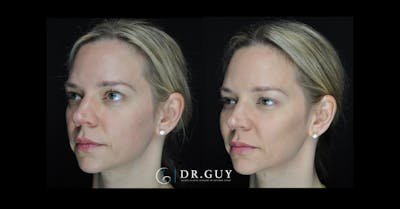 Fillers Before & After Gallery - Patient 368991 - Image 1
