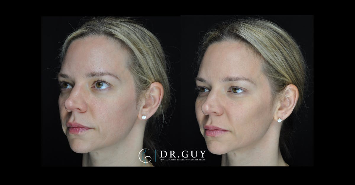 Fillers Before & After Gallery - Patient 368991 - Image 1