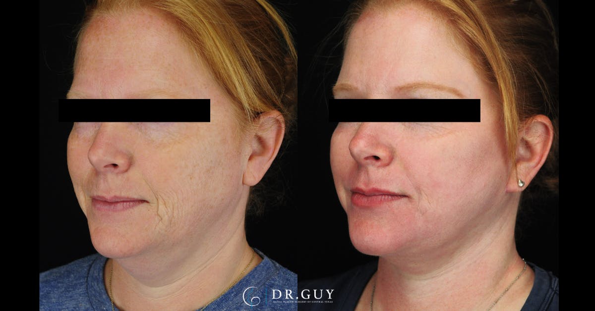 Laser Before & After Gallery - Patient 513630 - Image 5