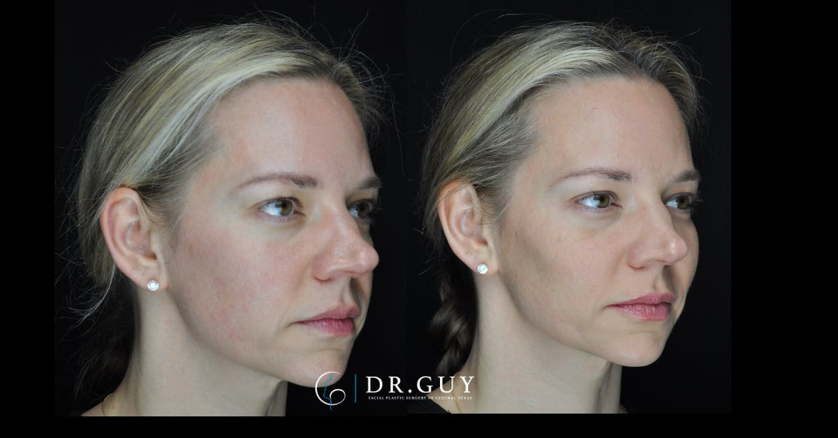 Fillers Before & After Gallery - Patient 368991 - Image 2