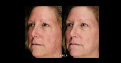 Laser Before & After Gallery - Patient 332735 - Image 1