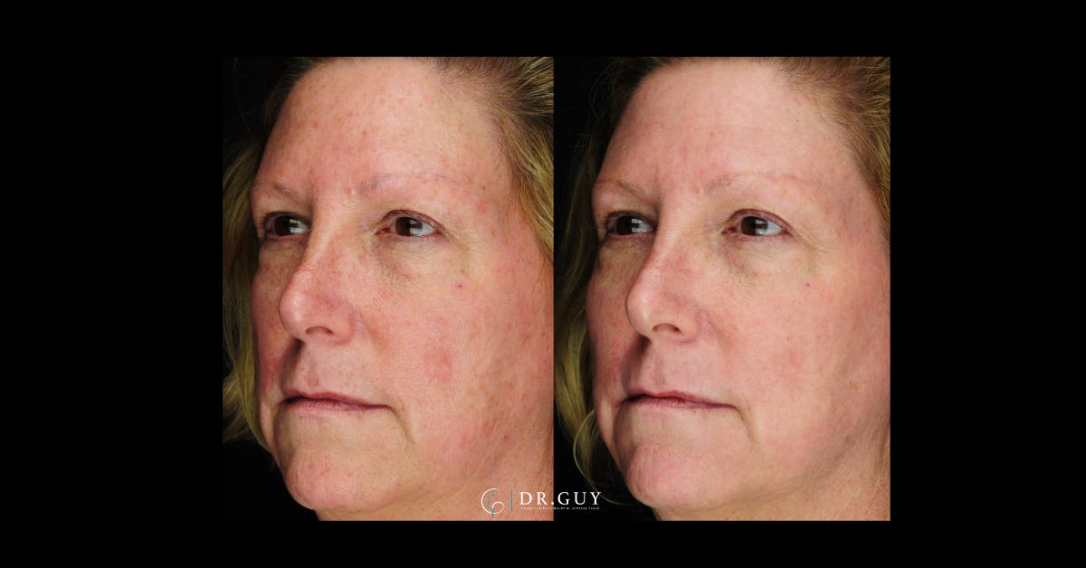 Laser Before & After Gallery - Patient 332735 - Image 1