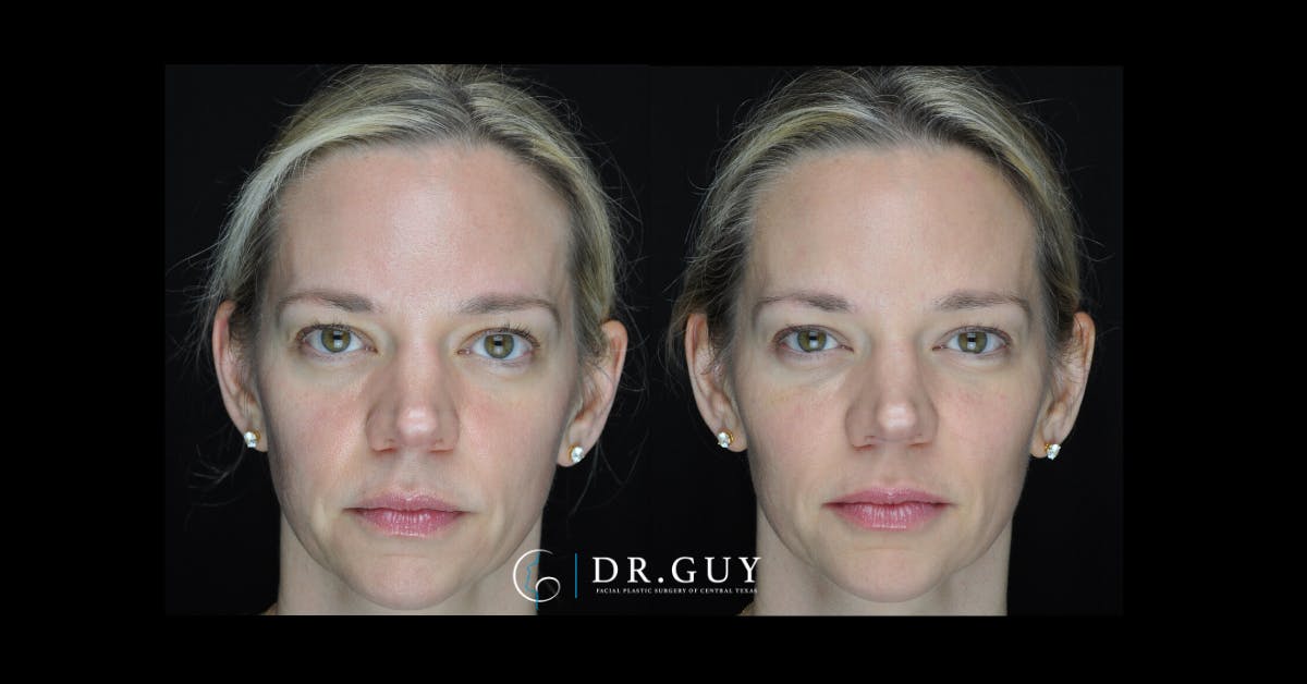 Fillers Before & After Gallery - Patient 368991 - Image 3