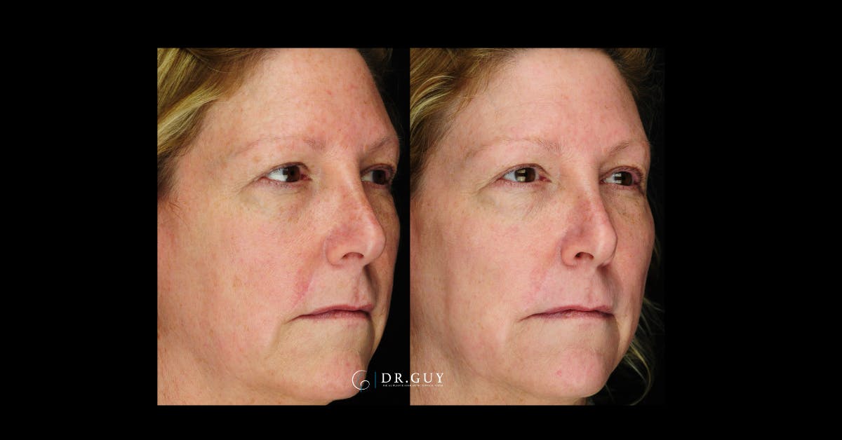 Laser Before & After Gallery - Patient 332735 - Image 2