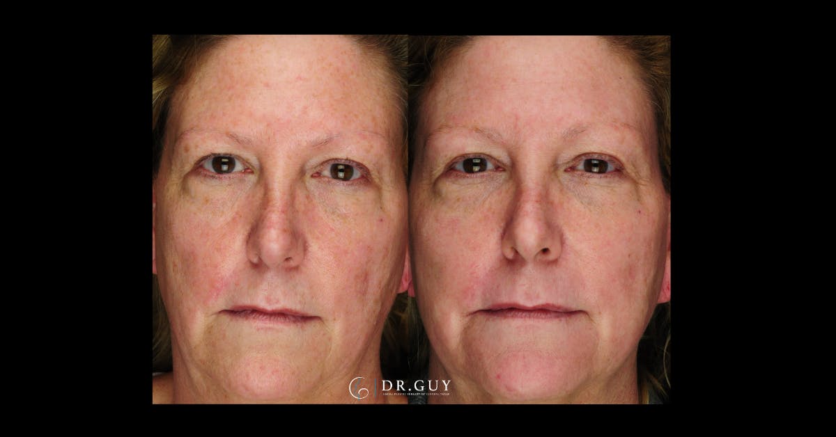 Laser Before & After Gallery - Patient 332735 - Image 3