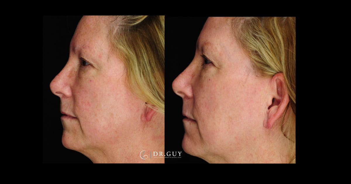 Laser Before & After Gallery - Patient 332735 - Image 4
