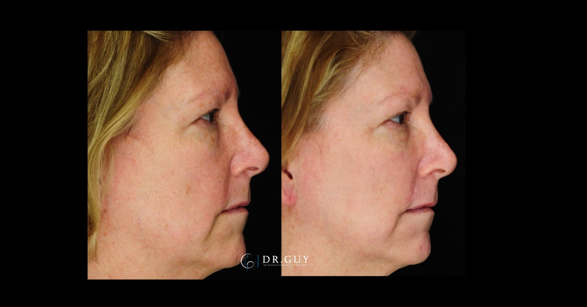 Laser Before & After Gallery - Patient 332735 - Image 5