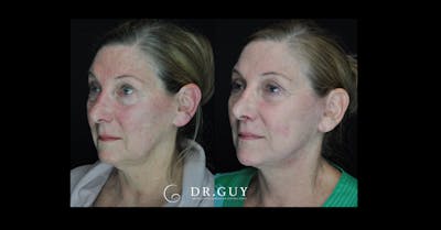 Laser Before & After Gallery - Patient 963987 - Image 1
