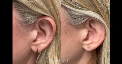 Earlobe Repair Before & After Gallery - Patient 209544 - Image 1