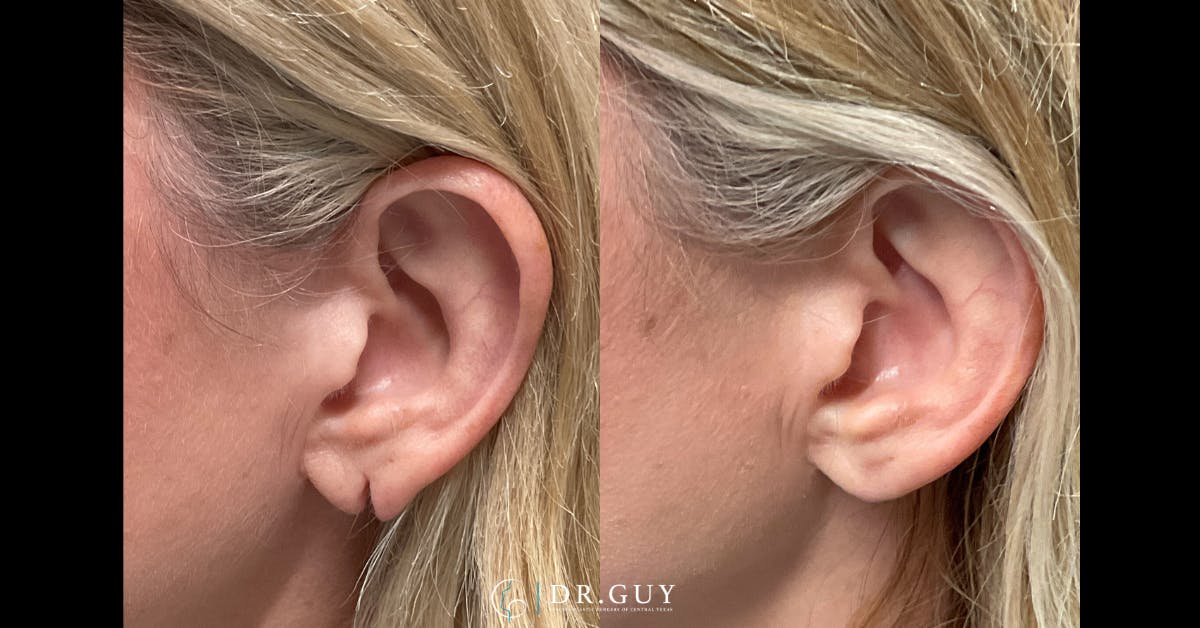 Earlobe Repair Before & After Gallery - Patient 209544 - Image 1