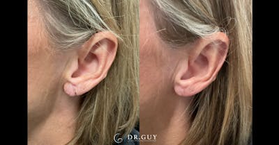 Earlobe Repair Before & After Gallery - Patient 526874 - Image 1