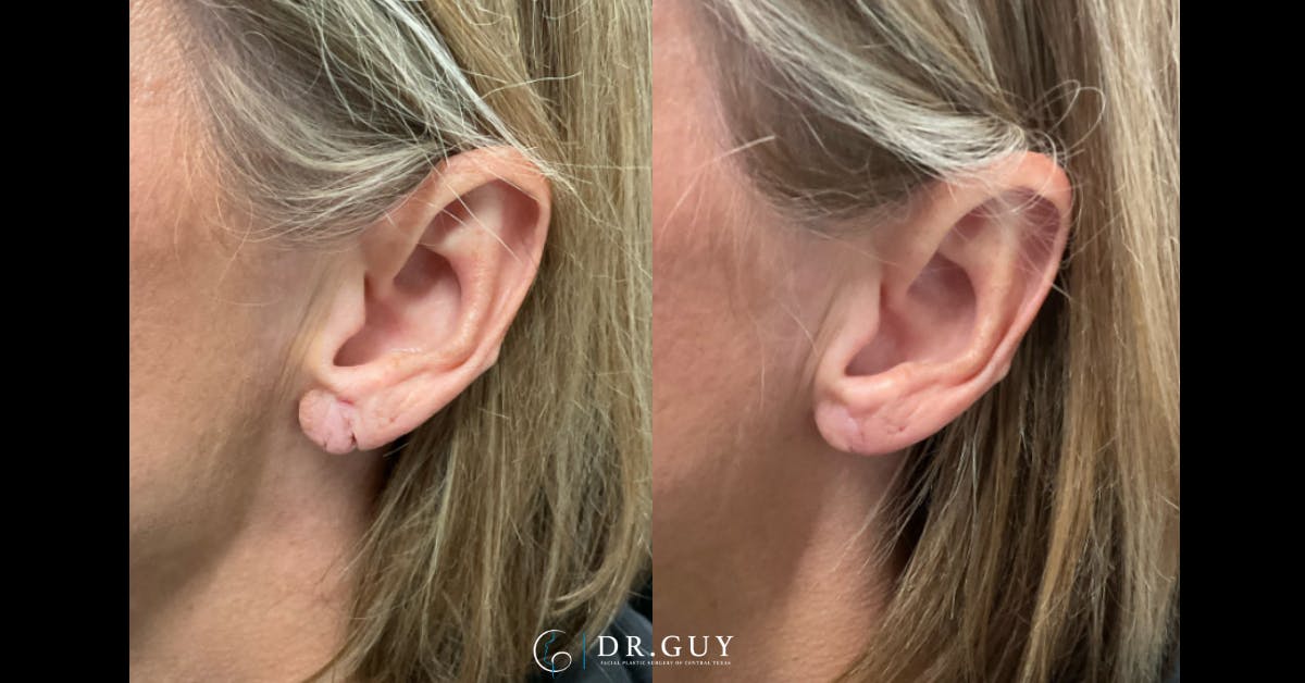 Earlobe Repair Before & After Gallery - Patient 526874 - Image 1