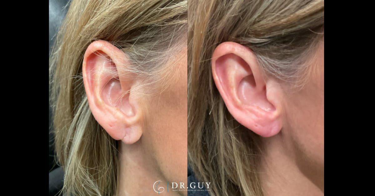 Earlobe Repair Before & After Gallery - Patient 526874 - Image 2