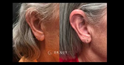 Earlobe Repair Before & After Gallery - Patient 234377 - Image 1