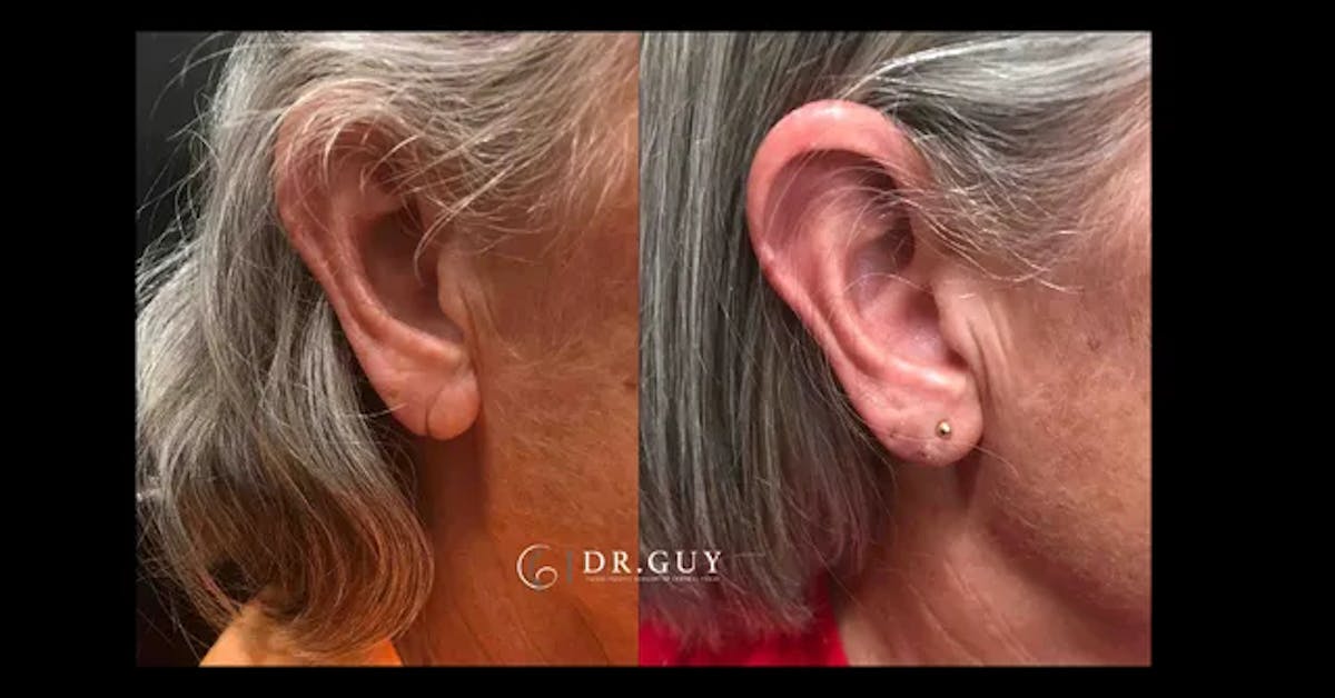 Earlobe Repair Before & After Gallery - Patient 234377 - Image 1