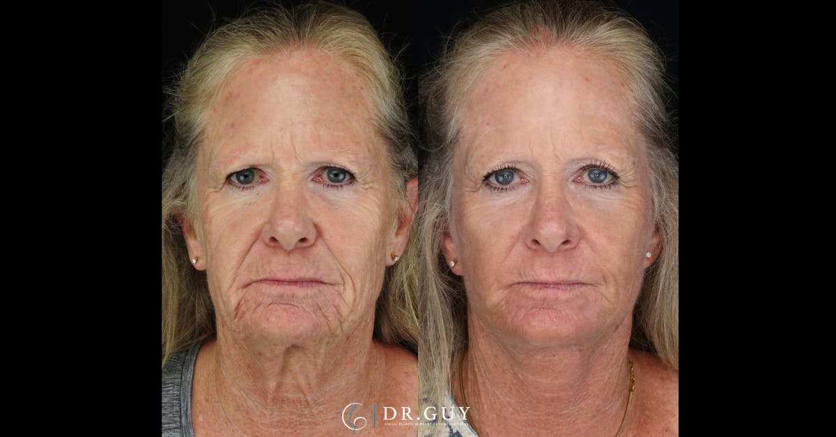 Laser Before & After Gallery - Patient 977061 - Image 3