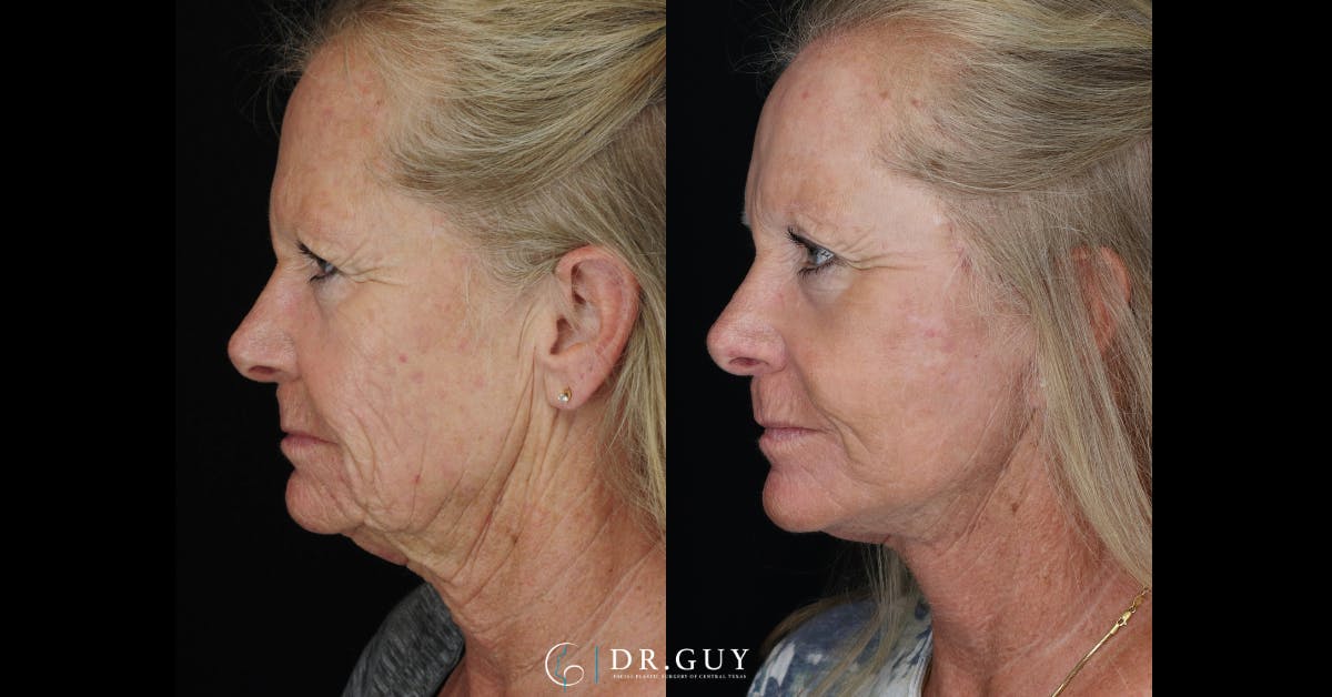 Laser Before & After Gallery - Patient 977061 - Image 4