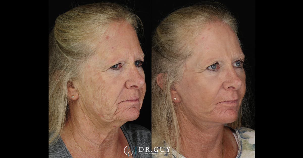 Laser Before & After Gallery - Patient 977061 - Image 1