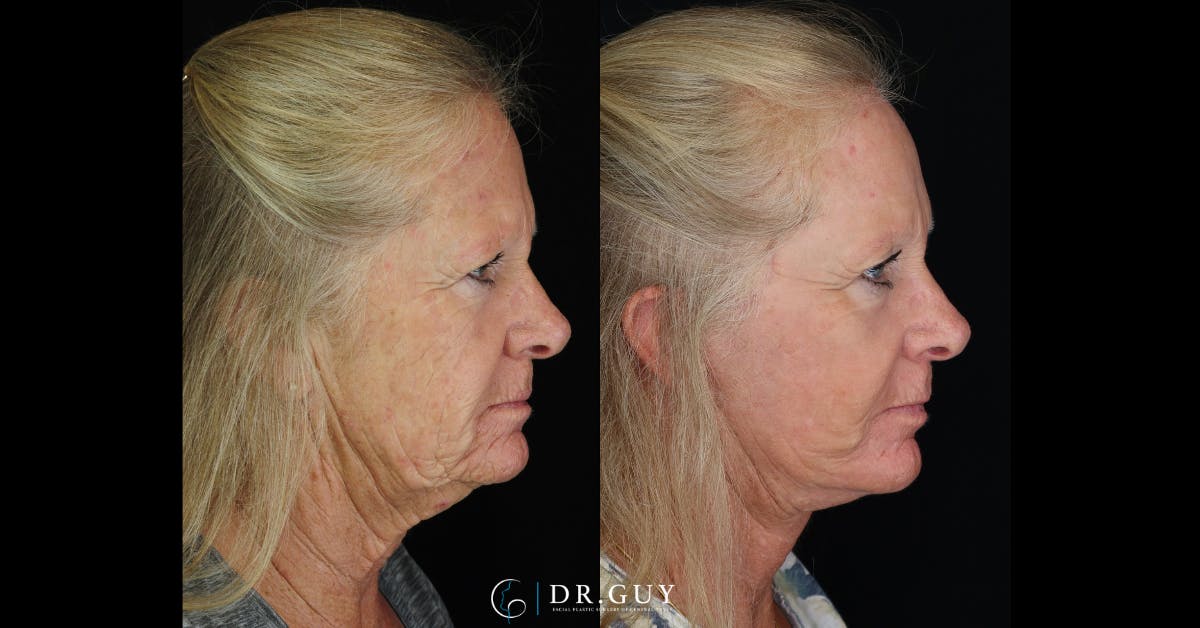Laser Before & After Gallery - Patient 977061 - Image 2