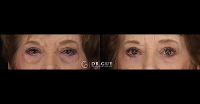 Lower Blepharoplasty Before & After Gallery - Patient 358508 - Image 1