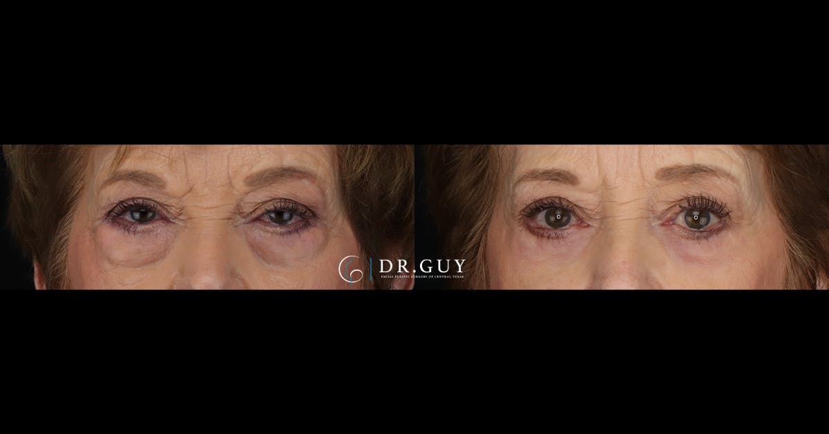 Lower Blepharoplasty Before & After Gallery - Patient 358508 - Image 1