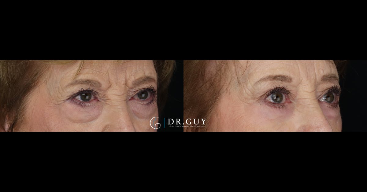 Lower Blepharoplasty Before & After Gallery - Patient 358508 - Image 4