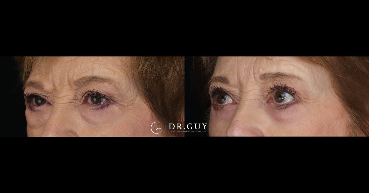 Lower Blepharoplasty Before & After Gallery - Patient 358508 - Image 2
