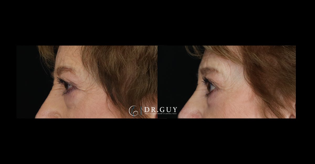Lower Blepharoplasty Before & After Gallery - Patient 358508 - Image 3